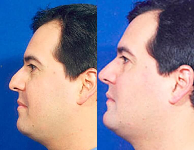 Chin Implants Before And After Patient 4 Case 3415 Left View