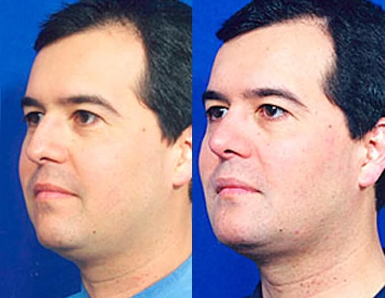 Chin Implants Before And After Patient 4 Case 3415 3/4th Left View