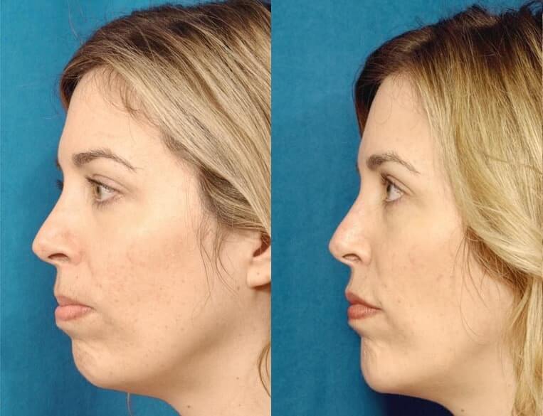 Chin Implants Before And After Patient 5 Case 3421 Left View