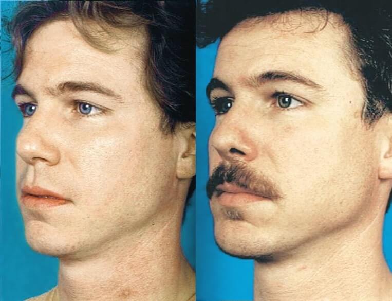Chin Implants Before And After Patient 6 Case 3425 3/4th Left View