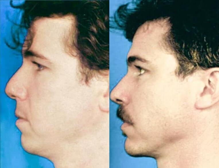 Chin Implants Before And After Patient 6 Case 3425 Left View