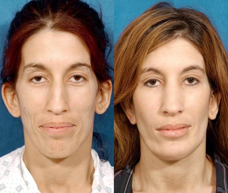 Chin Implants Before And After Patient 7 Case 3431 Front View