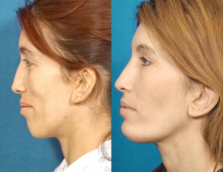 Chin Implants Before And After Patient 7 Case 3431 Left View