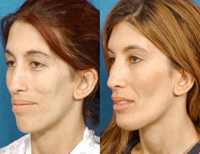 Chin Implants Before And After Patient 7 Case 3431 3/4th Left View