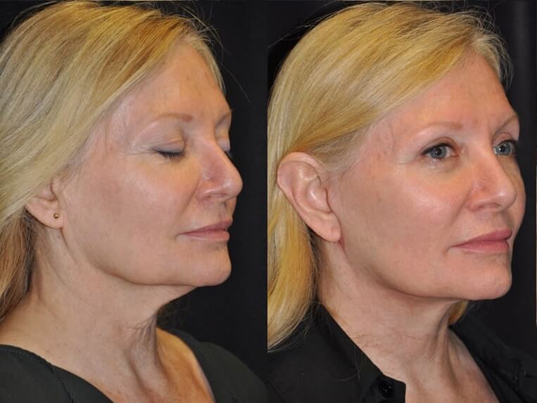 Facelift with Necklace © and upper blepharoplasty