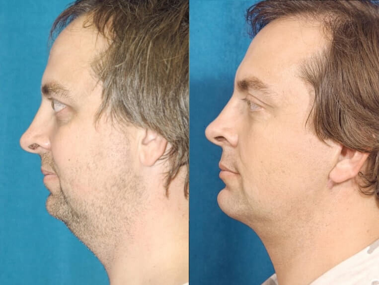 Eyelid Rejuvenation Before And After Patient 2 Case 3439 Left View