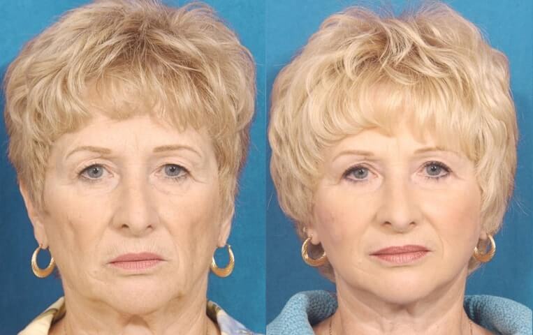Eyelid Rejuvenation Before And After Patient 3 Case 3445 Front View