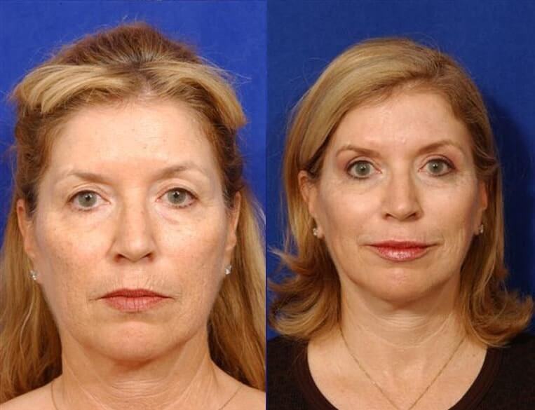 Eyelid Rejuvenation Before And After Patient 9 Case 3481 Front View