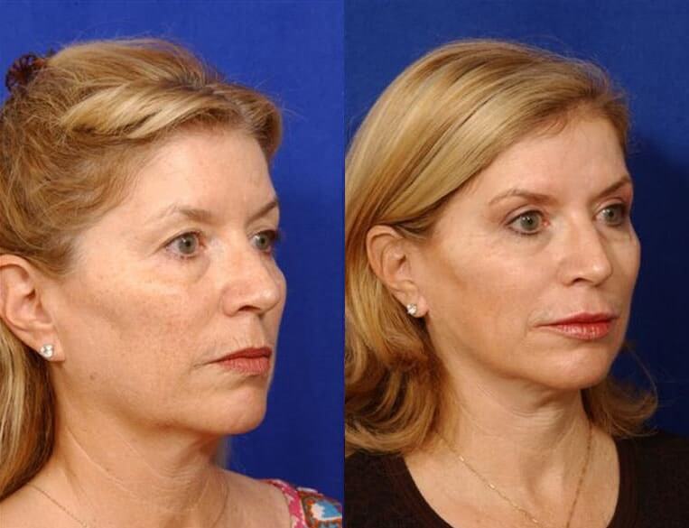 Eyelid Rejuvenation Before And After Patient 9 Case 3481 Right View