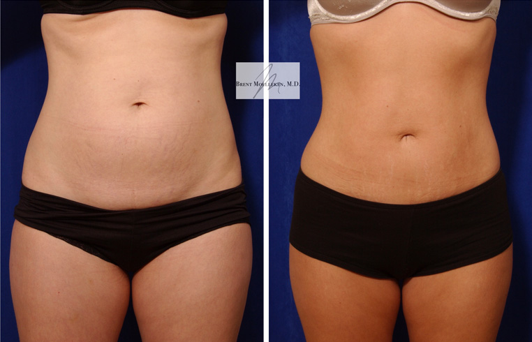 Hybrid Tummy Tuck® Before And After Patient 02 Case 3029 Front View