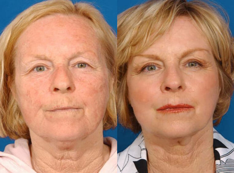 Laser Skin Resurfacing before and after patient 03 case 3995 front view