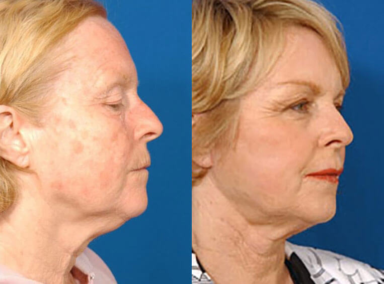Laser Skin Resurfacing before and after patient 03 case 3995 right view