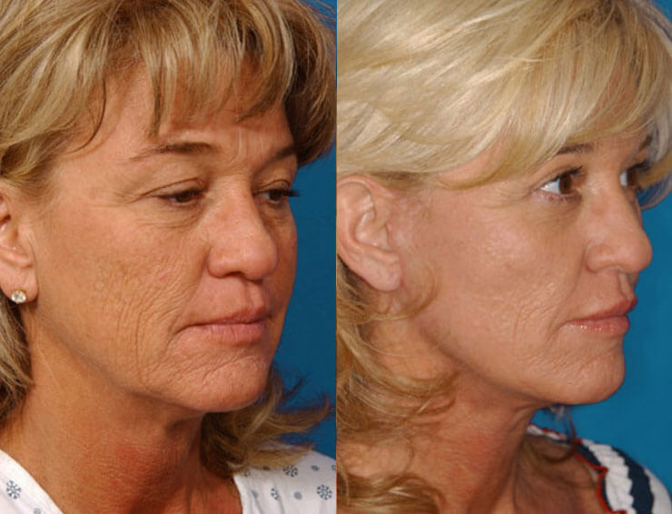 Facelift with Neck-lace procedure, Livefill to lips, superficial cheeklift with Livefill grafts to lower eyelids, upper blepharoplasty, Co2 laser resurfacing