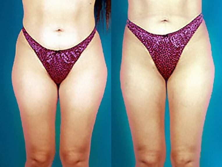 Liposuction to abdomen, waist, flanks, inner/outer thighs and knees