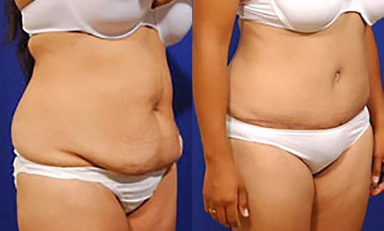 Full abdominoplasty with liposuction and liposculpture
