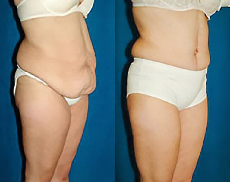 Abdominoplasty with flank extention, thighlift and liposuction