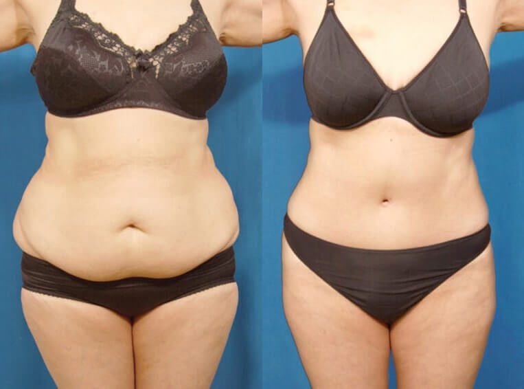 Full abdominoplasty with liposuction to flanks, abs, and waist