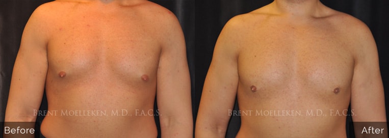 30 yr old male Gynecomastia/ Liposuction to chest Surgery