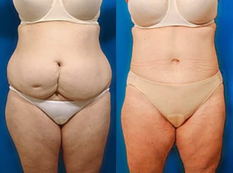 Abdominoplasty with flank extension, liposuction of waist and abodomen