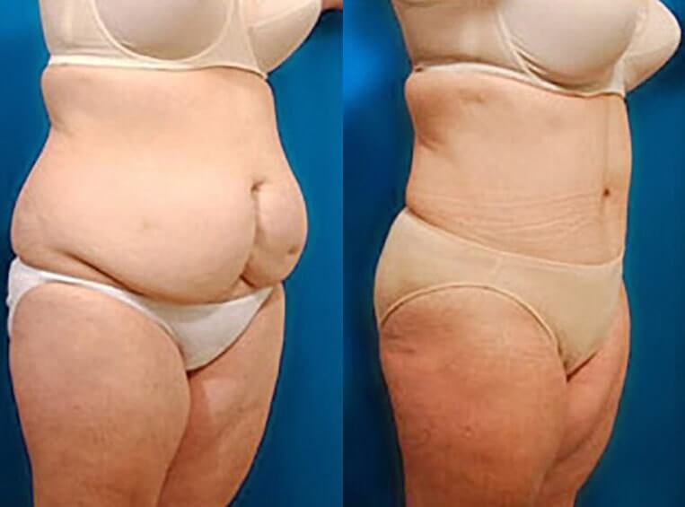 Abdominoplasty with flank extension, liposuction of waist and abodomen