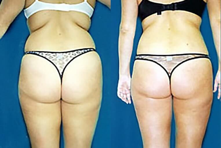 Liposuction to abdomen, waist, flanks, inner/outer thighs