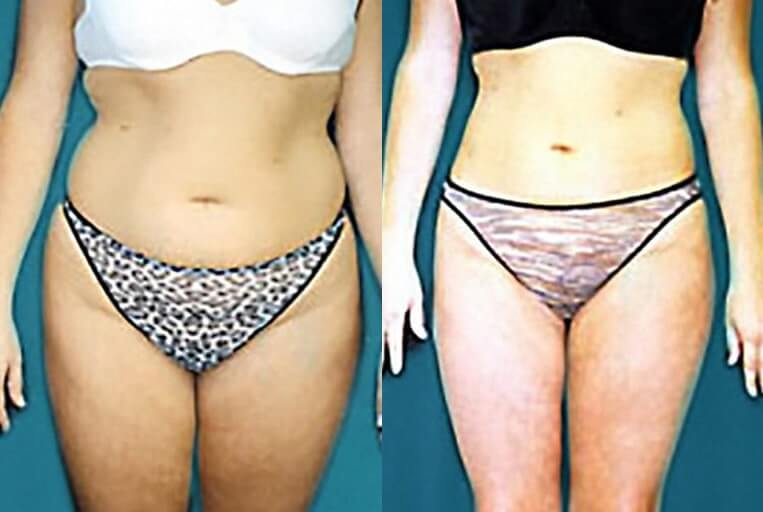 Liposuction to abdomen, waist, flanks, inner/outer thighs