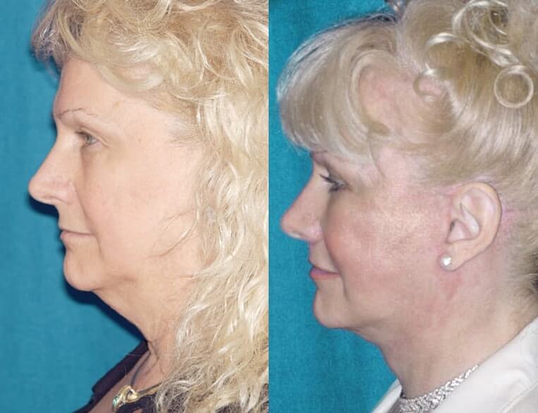 Livefill® Before And After Patient 11 Case 3731 Left View