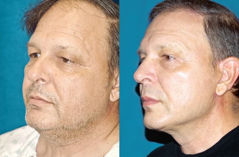 Livefill® Before And After Patient 12 Case 3745 Left View