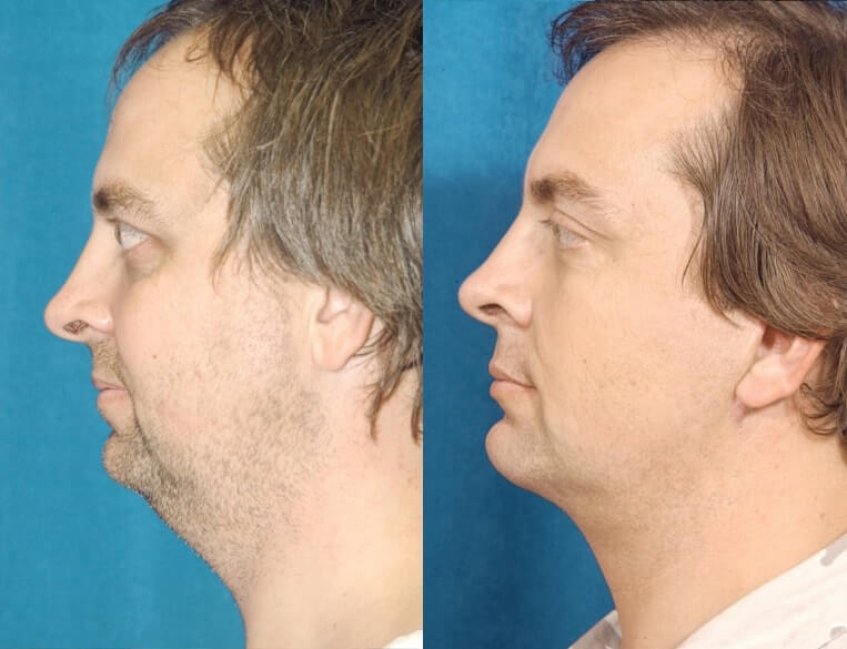 Livefill® Before And After Patient 3 Case 3671 Left View
