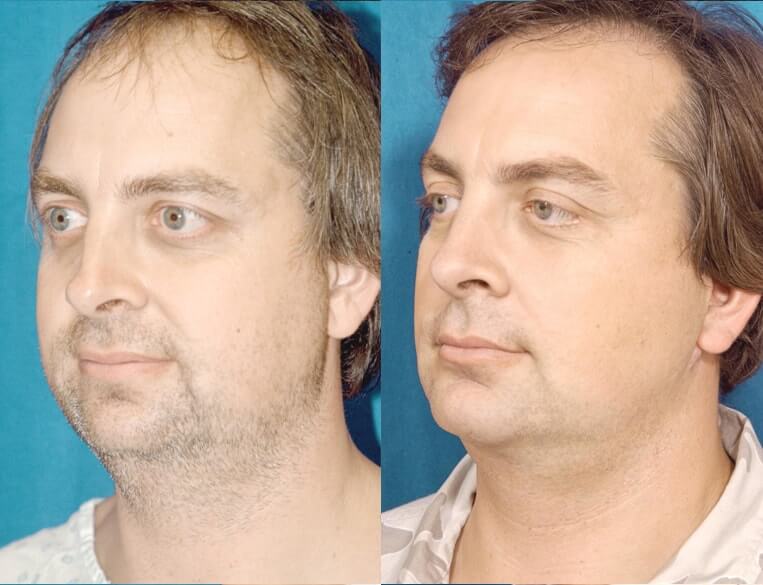 Livefill® Before And After Patient 3 Case 3671 3/4th Left View