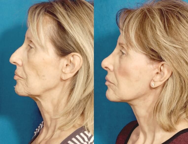 Livefill® Before And After Patient 4 Case 3679 Left View