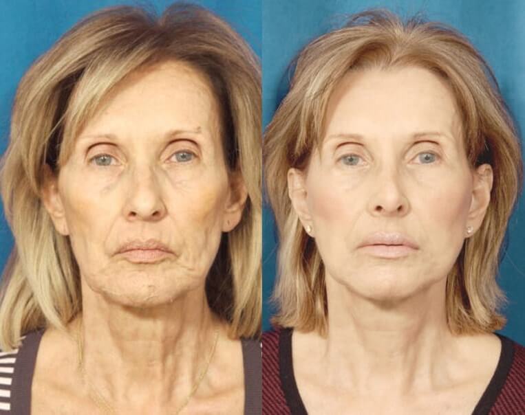 Livefill® Before And After Patient 4 Case 3679 Front View