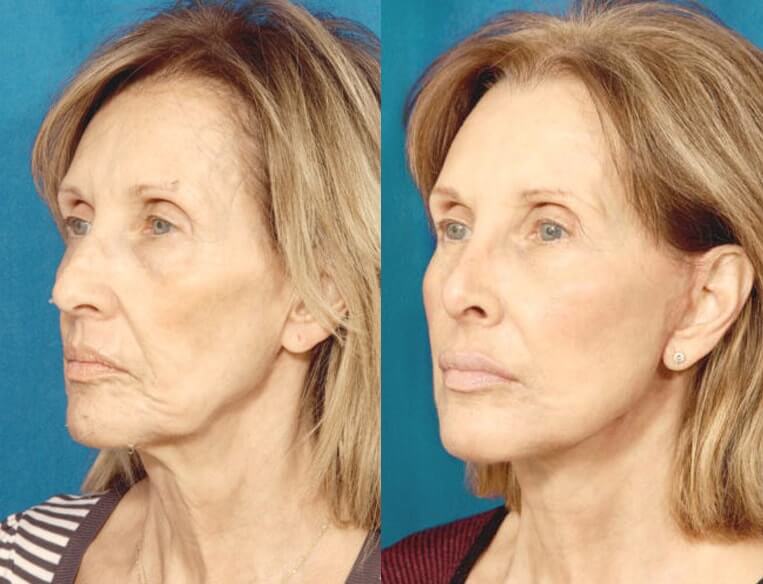 Livefill® Before And After Patient 4 Case 3679 3/4th Left View