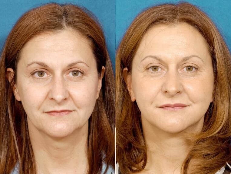 Livefill® Before And After Patient 9 Case 3711 Front View