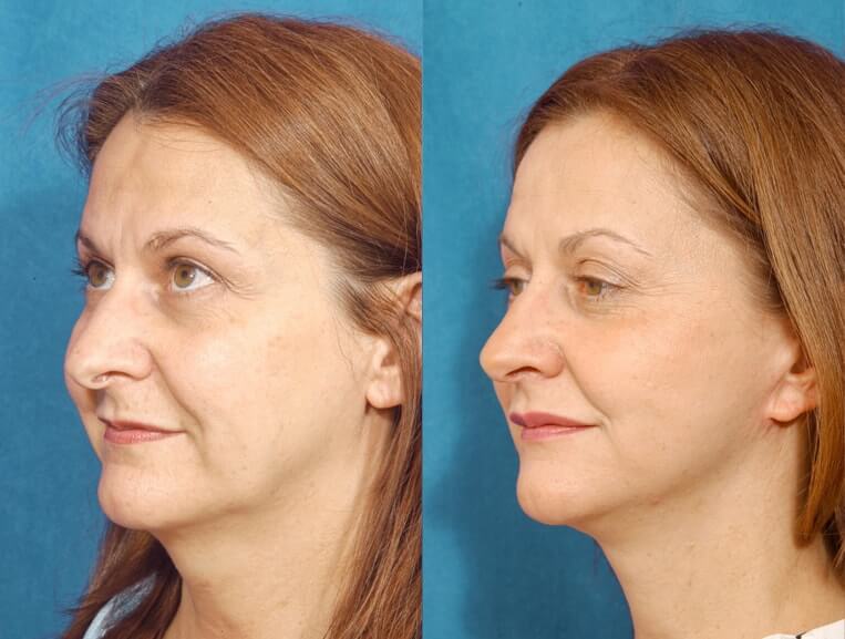 Livefill® Before And After Patient 9 Case 3711 3/4th Left View