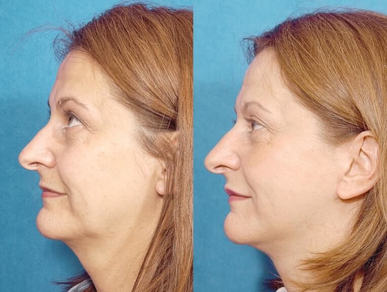 Livefill® Before And After Patient 9 Case 3711 Left View