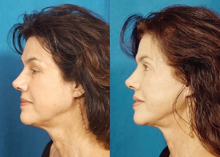 Livefill® Before And After Patient 10 Case 3719 Left View