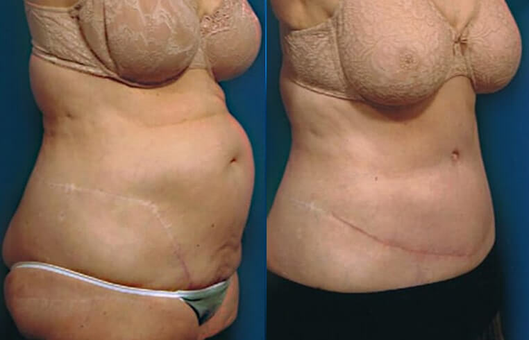 Abdominoplasty and liposuction to abs and flanks