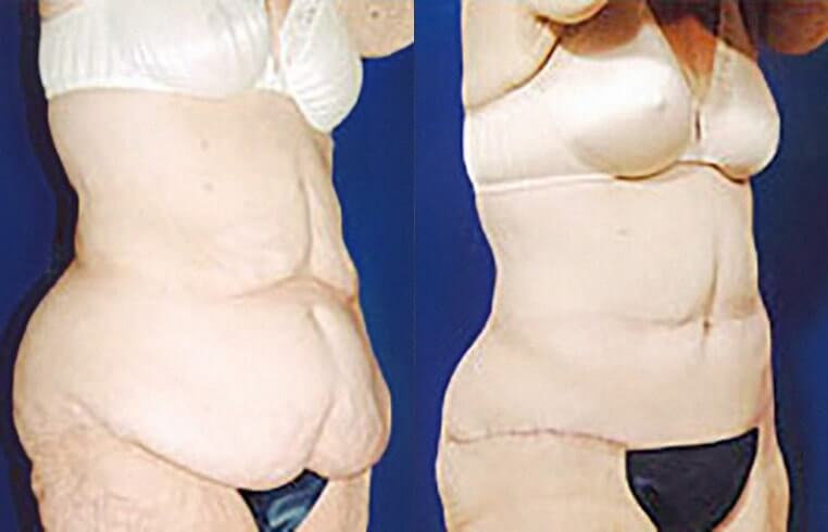 Abdominoplasty and bilateral flank panniculectomy
