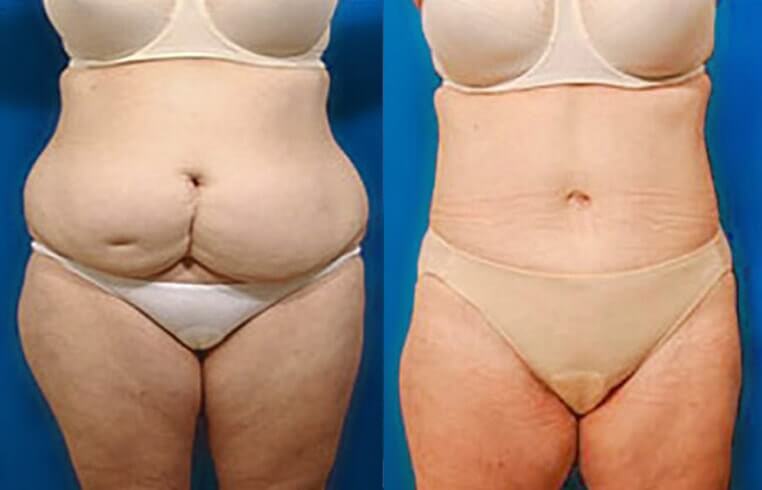 Massive Weight Loss before and after patient 03 case 3209 Front view