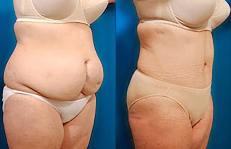 Massive Weight Loss before and after patient 03 case 3209 side view
