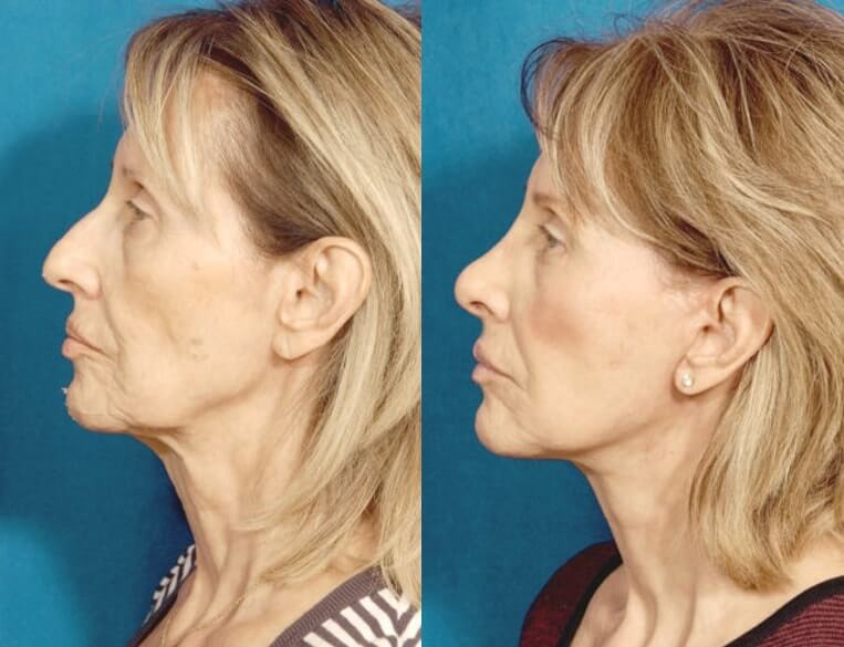 Neck-Lace® Before And After Patient 2 Case 3751 Left View