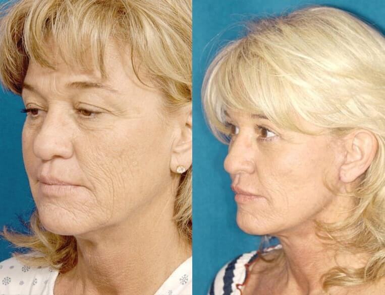 Neck-Lace® Before And After Patient 5 Case 3775 3/4th Left View