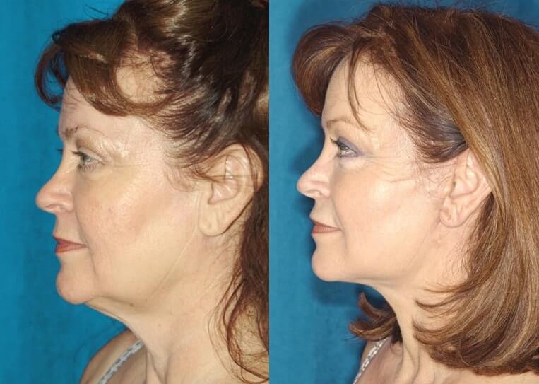 Neck-Lace® Before And After Patient 6 Case 3781 Left View