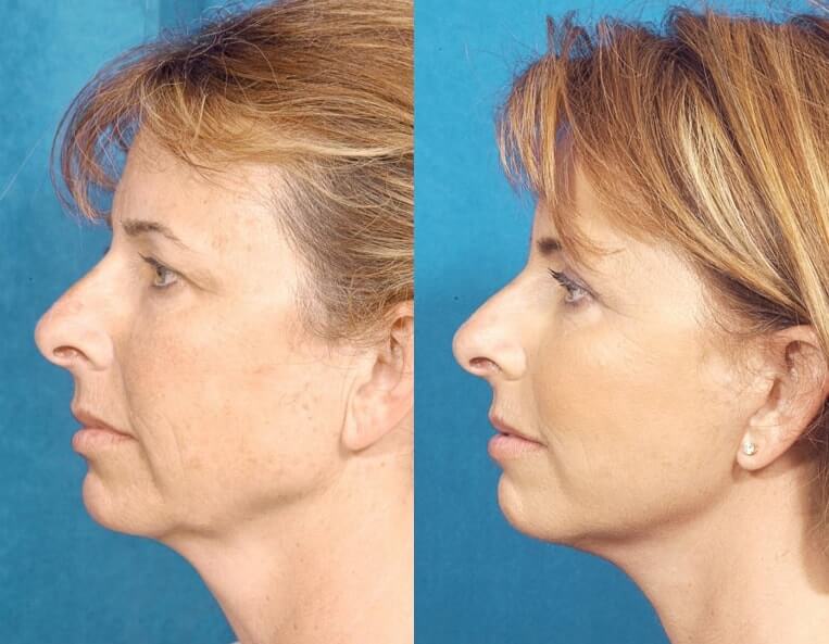 Neck-Lace® Before And After Patient 7 Case 3789 Left View