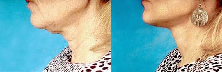 Neck lace before and after patient 8 case 3797 close up