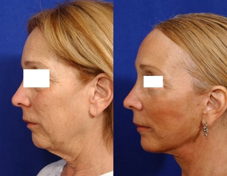 Necklift Before And After Patient 5 Case 3853 Left View