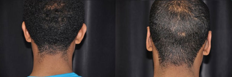 Otoplasty Ear Surgery before and after patient 01 case 4992 back view