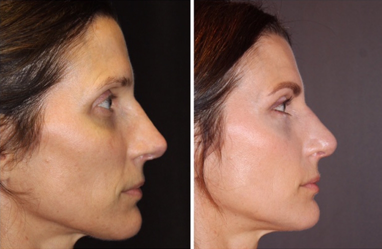 Rhinoplasty Before And After Patient 22 Case 5522 SideView