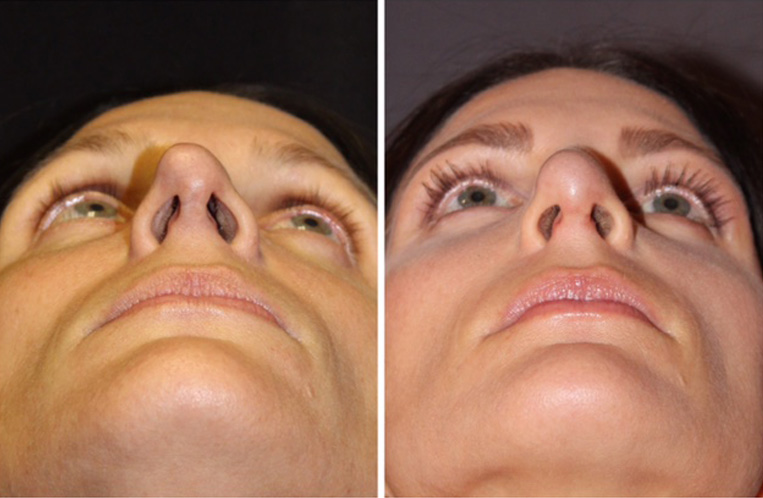Rhinoplasty Before And After Patient 22 Case 5522 Top View